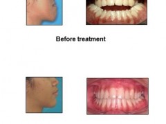 Kulliyyah Dentistry Offers Comprehensive Orthognatic Treatment in IIUM